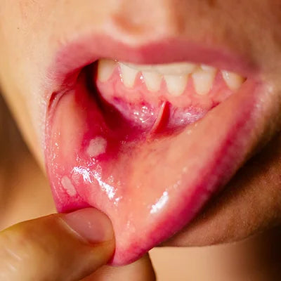 Mouth-Ulcers