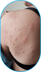 Allergy