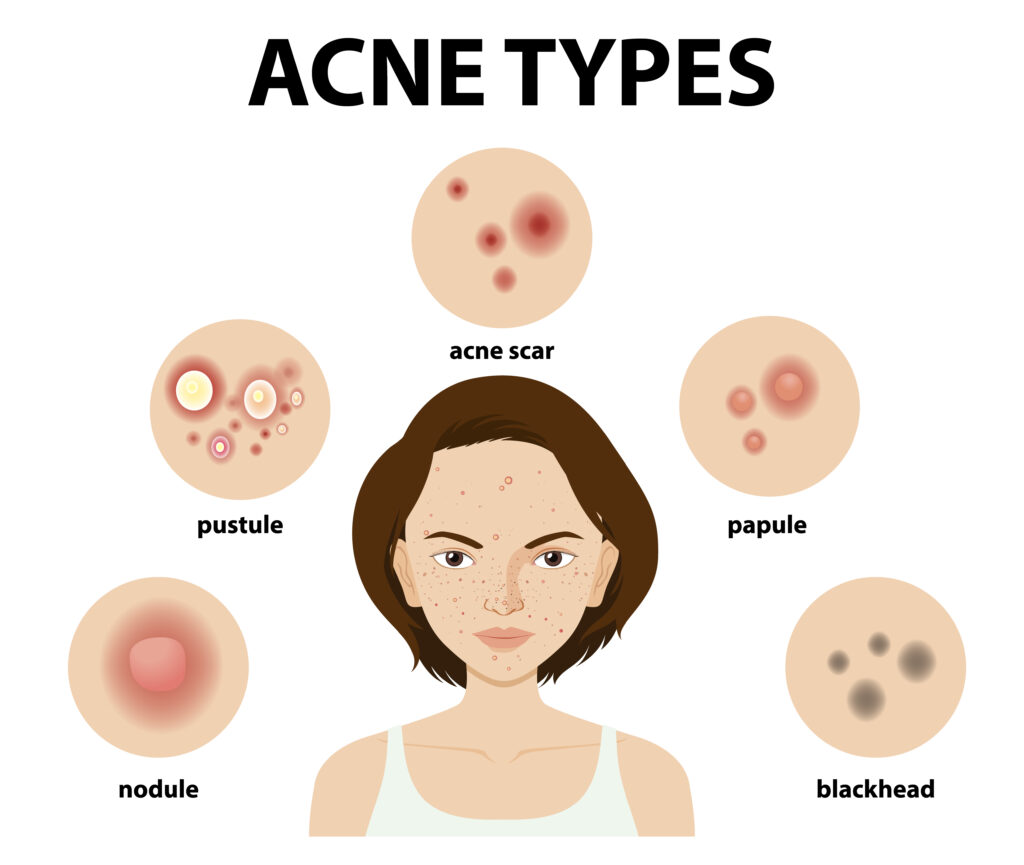 Types of acne 