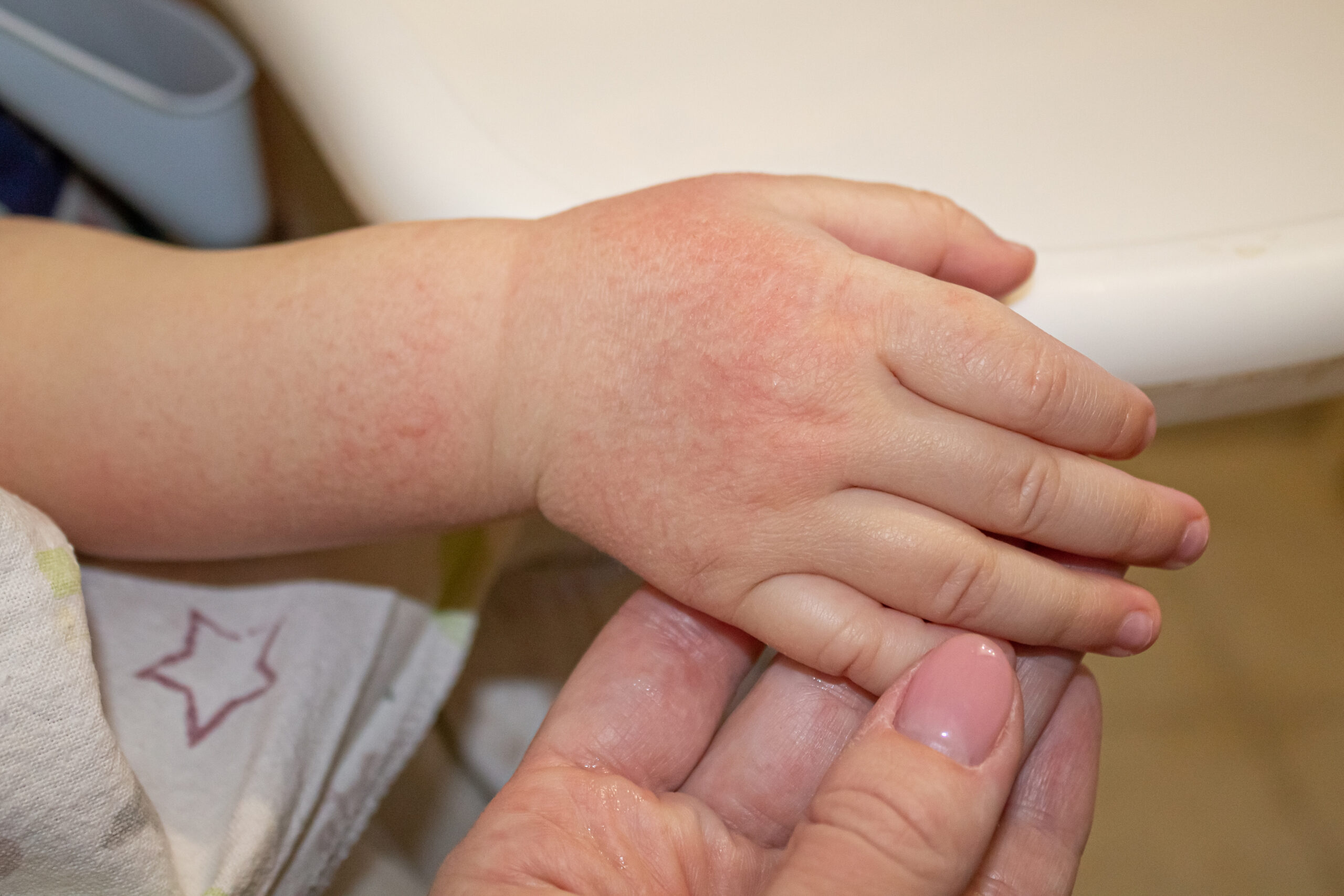 treat eczema and dermatitis with homeopathy medicine