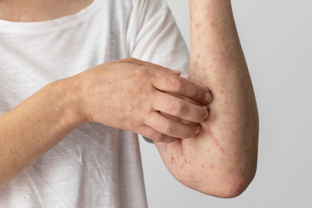 eczema and dermatitis problem
